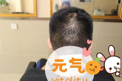 -大麦微针植发丨全国连锁