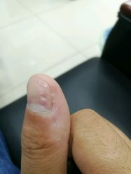 点击看大图 -德哥灰指甲脚气甲沟炎跖疣护理