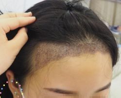 -大麦微针植发丨全国连锁