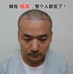 -碧莲盛·不剃发植发