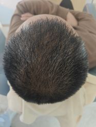 -大麦微针植发丨全国连锁