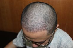 点击看大图 -大麦微针植发丨全国连锁