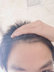 -大麦微针植发丨全国连锁