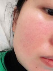 体验后-More摩尔医美の注射线雕光电中心