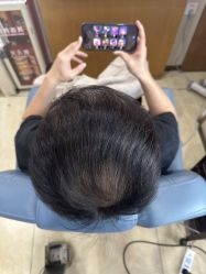 -大麦微针植发全国连锁