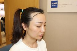 -大麦微针植发丨全国连锁