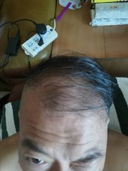 -大麦微针植发全国连锁