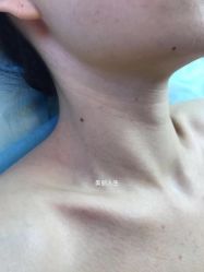 -爱莎扁平疣·汗管瘤·斑痣中心