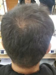 -碧莲盛·不剃发植发