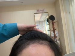 -碧莲盛·不剃发植发