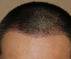 -大麦微针植发全国连锁