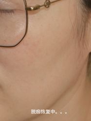 -清疣美疣·痣·斑净肤中心