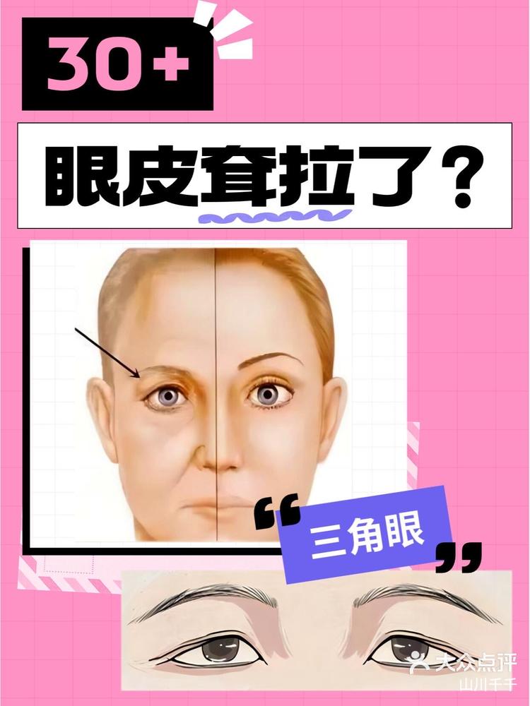 眼皮下垂变三角眼图片图片