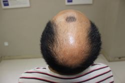 -大麦微针植发全国连锁