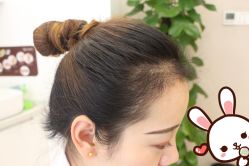 点击看大图 -大麦微针植发丨全国连锁