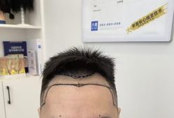 -大麦微针植发全国连锁