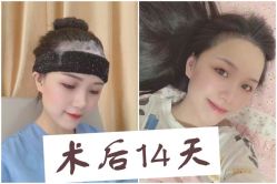 -大麦微针植发全国连锁