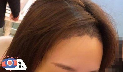 -大麦微针植发丨全国连锁