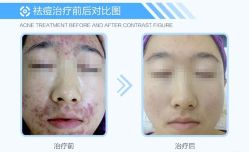 -蕾特恩·专业祛痘国际连锁