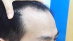 体验前-雍禾植发全国连锁