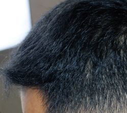 -大麦微针植发全国连锁