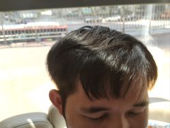 -碧莲盛·不剃发植发