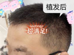 -大麦微针植发全国连锁