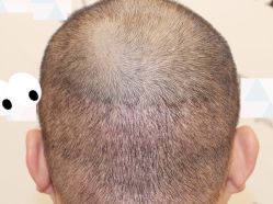 -大麦微针植发全国连锁