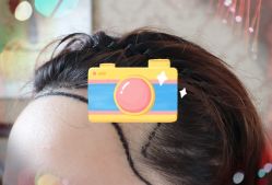 -大麦微针植发全国连锁