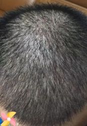 -大麦微针植发丨全国连锁