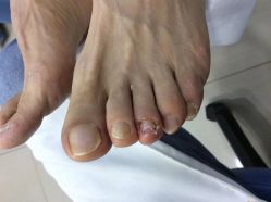 -德哥灰指甲脚气甲沟炎跖疣护理