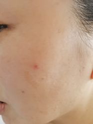 体验前-四川米兰柏羽医学美容医院