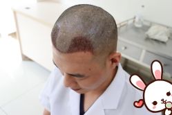 -大麦微针植发丨全国连锁