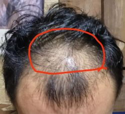 -碧莲盛·不剃发植发