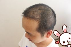 点击看大图 -大麦微针植发丨全国连锁