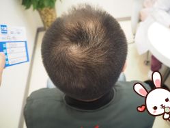 -大麦微针植发丨全国连锁