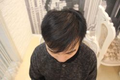 点击看大图 -大麦微针植发丨全国连锁