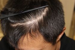 -大麦微针植发全国连锁