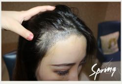 点击看大图 -大麦微针植发全国连锁