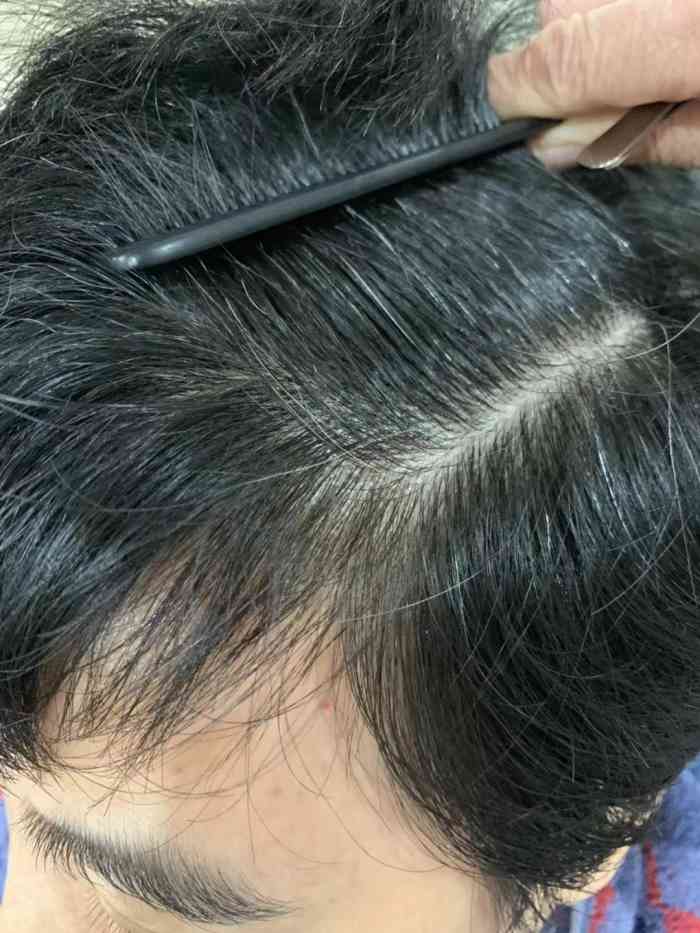 黑茸老姜王脱发生发 白发转黑