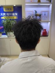点击看大图 -大麦微针植发全国连锁