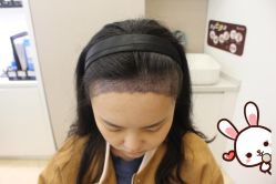 -大麦微针植发丨全国连锁