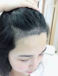 -大麦微针植发全国连锁