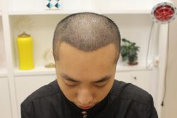 -大麦微针植发丨全国连锁