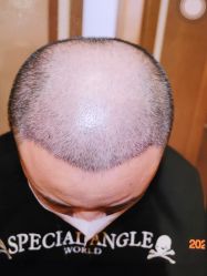 体验前-大麦微针植发全国连锁