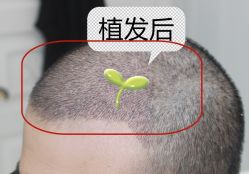 -大麦微针植发全国连锁
