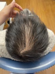 体验前-大麦微针植发全国连锁