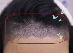 -大麦微针植发全国连锁