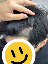 -大麦微针植发全国连锁