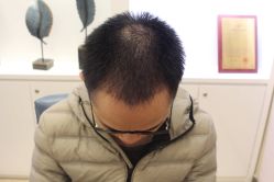 -大麦微针植发丨全国连锁